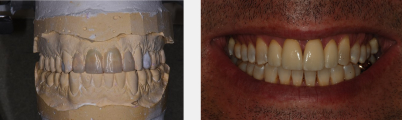 Some Questions I’ve Been Asked About Occlusion Over the Years, Part 2 CarlSteinberg some questions ive been asked about occlusion over the years part 2 Fig.3