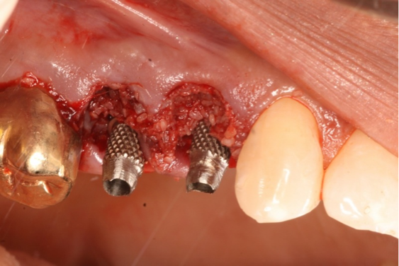 Tips on Fabricating Implant Provisionals and Custom Healing Abutments Carson Implant Provisionals Featured Image