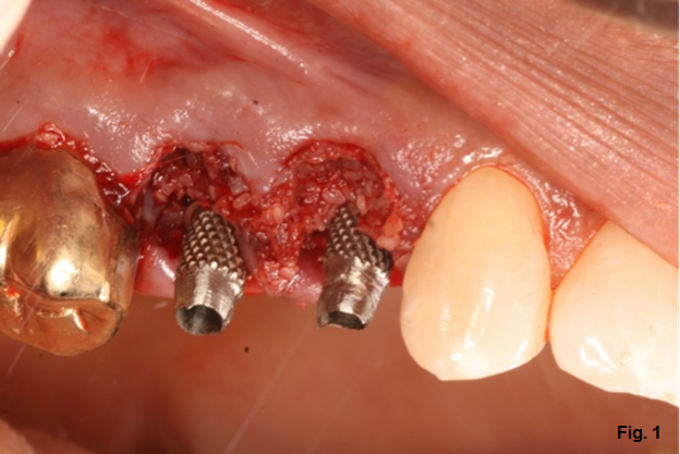efrver Carson Implant Provisionals Figure 1