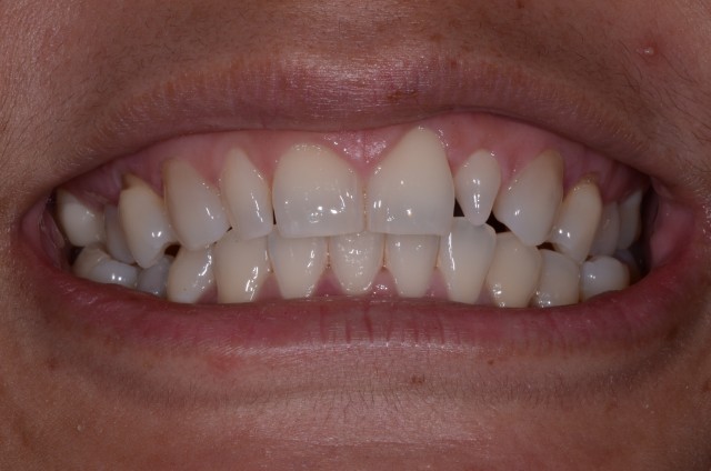 How To Do No-Prep Restorations Carson No Prep Restorations Featured Image