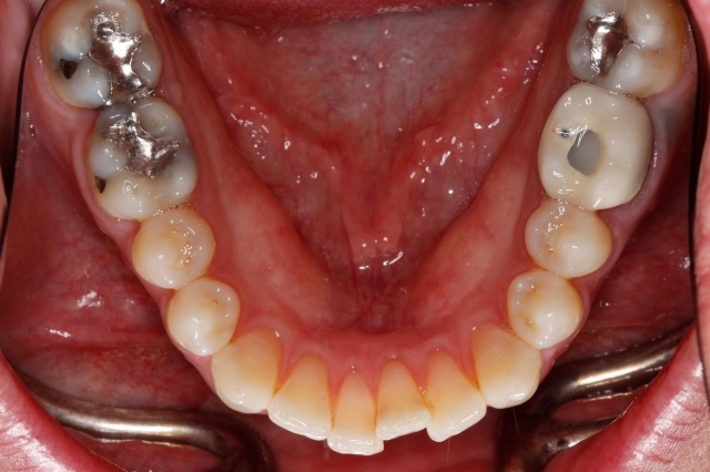 Six Tips to Improve Your Occlusal Photographs Courntey Lavigne Six Tips to Improve Your Occlusal Photographs Figure 1