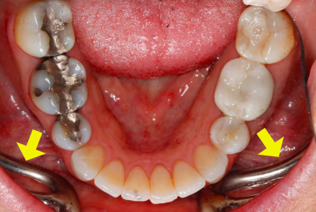 Six Tips to Improve Your Occlusal Photographs Courntey Lavigne Six Tips to Improve Your Occlusal Photographs Figure 3