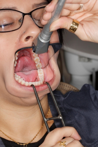 Six Tips to Improve Your Occlusal Photographs Courntey Lavigne Six Tips to Improve Your Occlusal Photographs Figure 4