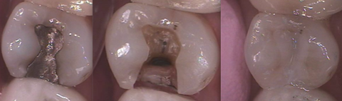 Courtney Lavigne SonicFill As Good As It Sounds Figure 2