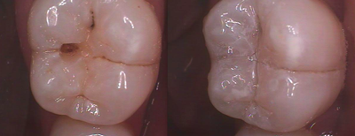 Courtney Lavigne SonicFill As Good As It Sounds Figure 3