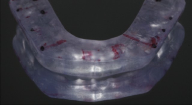 The Diagnosis-First Approach to Occlusal Splints