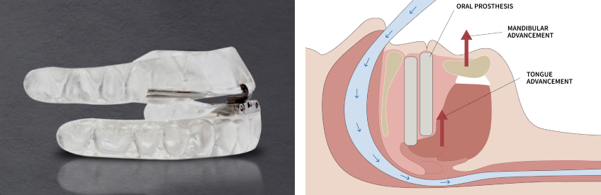 The Diagnosis-First Approach to Occlusal Splints Curt Ringhofer Diagnosis First Approach Fig1