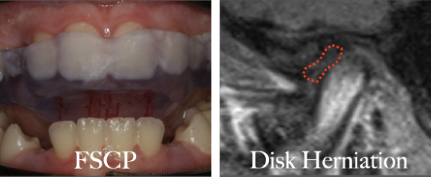 The Diagnosis-First Approach to Occlusal Splints Curt Ringhofer Diagnosis First Approach Fig2a