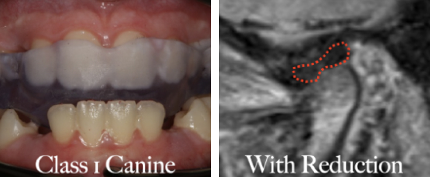 The Diagnosis-First Approach to Occlusal Splints Curt Ringhofer Diagnosis First Approach Fig2c