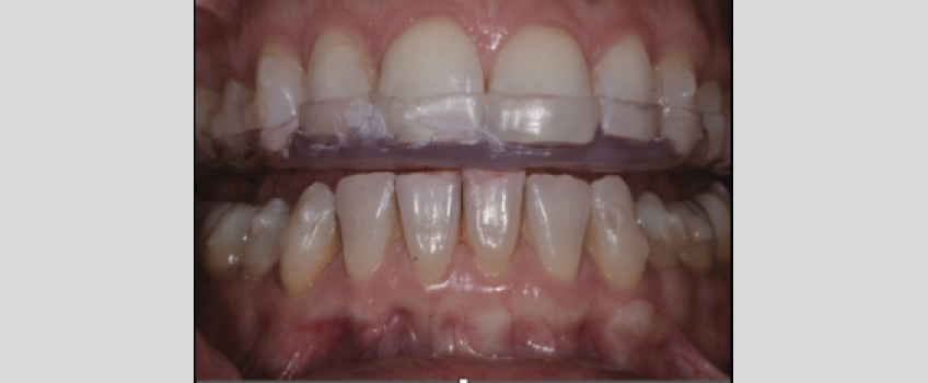 The Diagnosis-First Approach to Occlusal Splints Curt Ringhofer Diagnosis First Approach Fig3