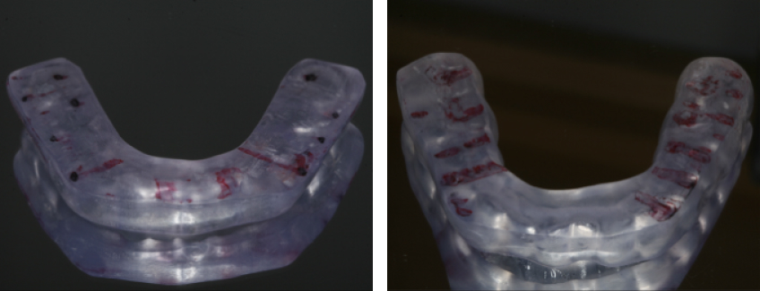 The Diagnosis-First Approach to Occlusal Splints Curt Ringhofer Diagnosis First Approach Fig4