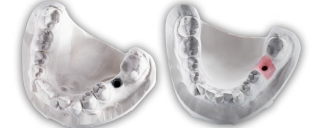 The Implant Working Cast: 4 Steps for Fabricating a Soft Tissue Cast Darin Dichter The Implant Working Cast Featured Image