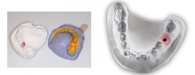 The Implant Working Cast: 4 Steps for Fabricating a Soft Tissue Cast Darin Dichter The Implant Working Cast Figure 11