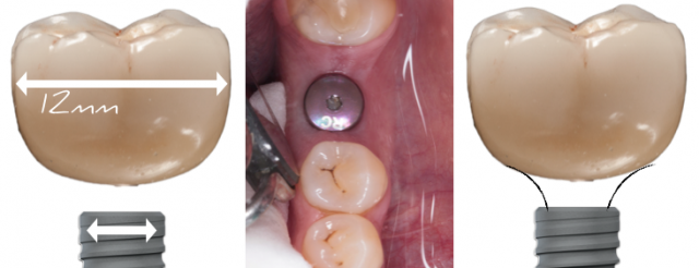 The Implant Working Cast: 4 Steps for Fabricating a Soft Tissue Cast Darin Dichter The Implant Working Cast Figure 2