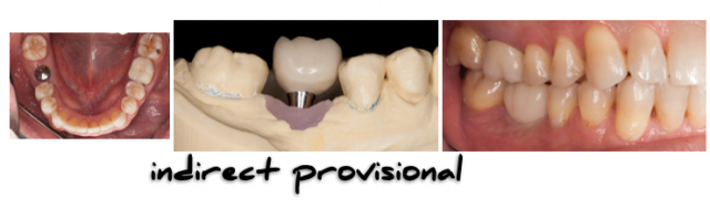 The Implant Working Cast: 4 Steps for Fabricating a Soft Tissue Cast Darin Dichter The Implant Working Cast Figure 4