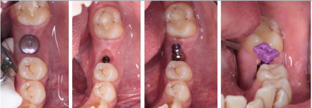 The Implant Working Cast: 4 Steps for Fabricating a Soft Tissue Cast Darin Dichter The Implant Working Cast Figure 6
