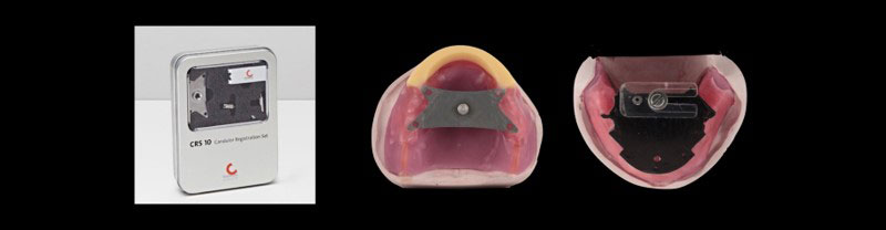 Occlusal Vertical Dimension and the Edentulous Patient: Methods for Recording OVD DarinDichter OccVertDimensionEndentulousPt Fig.3