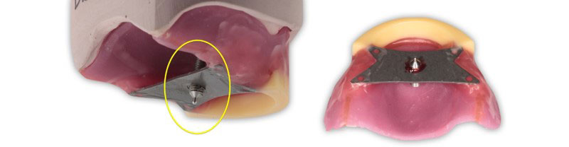 Occlusal Vertical Dimension and the Edentulous Patient: Methods for Recording OVD DarinDichter OccVertDimensionEndentulousPt Fig.4