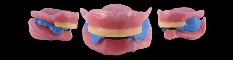 Occlusal Vertical Dimension and the Edentulous Patient: Methods for Recording OVD DarinDichter OccVertDimensionEndentulousPt Fig.5
