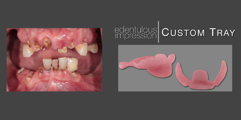 Options for Improving Clinical Efficiency When Fabricating New Removable Complete Dentures DarinDichter OptionsImprovingClinicalEffRemovableCompDenture Fig.2