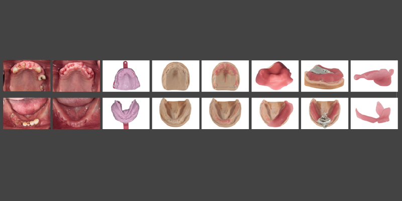 Options for Improving Clinical Efficiency When Fabricating New Removable Complete Dentures DarinDichter OptionsImprovingClinicalEffRemovableCompDenture Fig.3