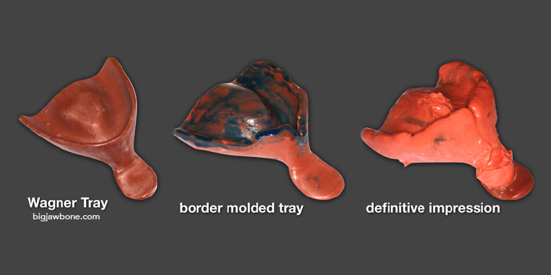 Options for Improving Clinical Efficiency When Fabricating New Removable Complete Dentures DarinDichter OptionsImprovingClinicalEffRemovableCompDenture Fig.5