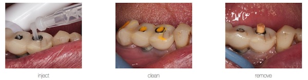 A Rapid Technique for Closing Screw Access Channels DarinDichter a rapid technique for closing screw access channels Fig.1