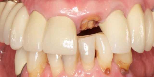 DarinDichter loading protocols for dental implants FeaturedImage