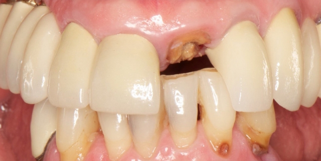 Loading Protocols for Dental Implants DarinDichter loading protocols for dental implants Fig.1