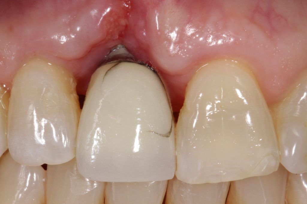 Loading Protocols for Dental Implants DarinDichter loading protocols for dental implants Fig.3