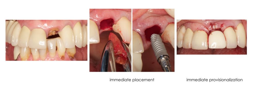 Loading Protocols for Dental Implants DarinDichter loading protocols for dental implants Fig.5