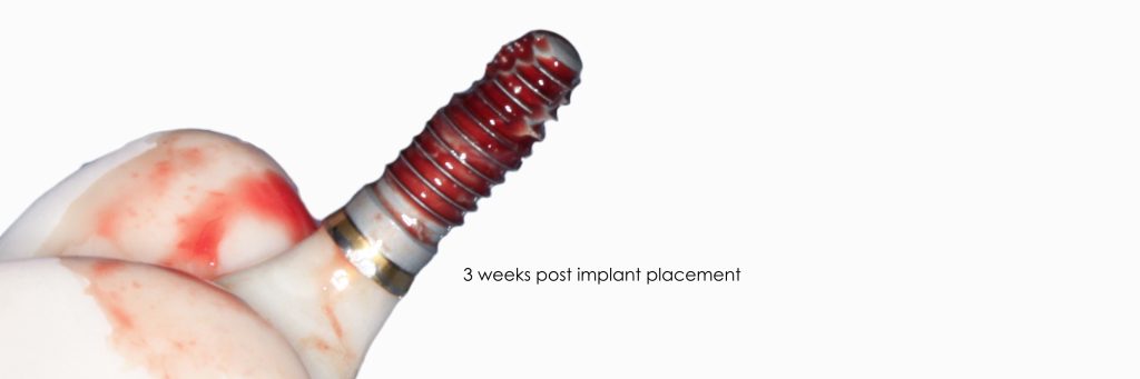 Loading Protocols for Dental Implants DarinDichter loading protocols for dental implants Fig.6