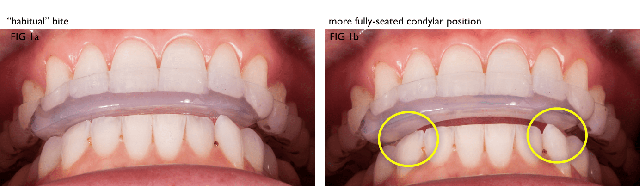 Modifying an Anterior Bite Plane With DURASPLINT LC DarinDichter modifying an anterior bite plane with durasplint Fig.1