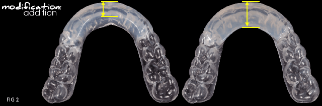 Modifying an Anterior Bite Plane With DURASPLINT LC DarinDichter modifying an anterior bite plane with durasplint Fig.2