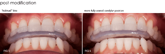 Modifying an Anterior Bite Plane With DURASPLINT LC DarinDichter modifying an anterior bite plane with durasplint Fig.6