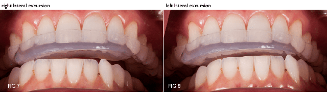 Modifying an Anterior Bite Plane With DURASPLINT LC DarinDichter modifying an anterior bite plane with durasplint Fig.7