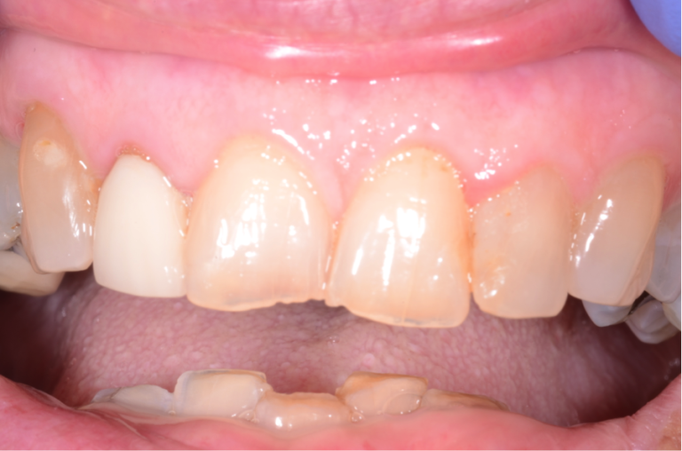 Shade Selection in the Anterior