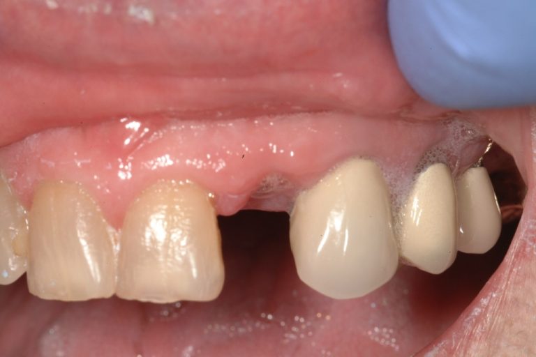 Ovate Pontic Maryland Bridges for Implant Temporaries