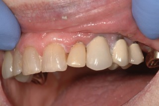 Ovate Pontic Maryland Bridges for Implant Temporaries DarinOBryan ovate pontic maryland bridges for implant temporaries Fig.2