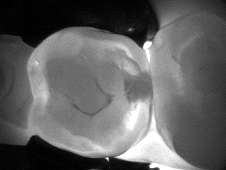 Caries Detection Tools: Select the Best for Your Practice Dave St. Ledger Caries Detection Tools Figure 5