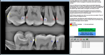 Caries Detection Tools: Select the Best for Your Practice Dave St. Ledger Caries Detection Tools Figure 7