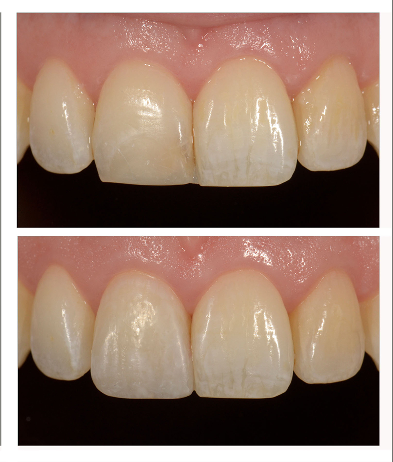 Basics of Layering Composites in the Esthetic Zone DawnWehking BasicsLayeringComposites Bonding Fig.3A 3B