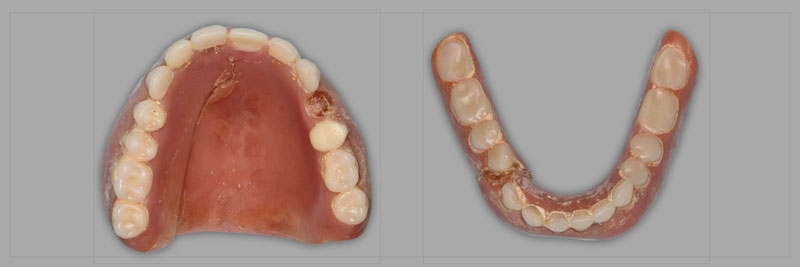 Using the Matrix Technique for Repairing Debonded Denture Teeth Dichter using matrix repairing debonded teeth 01
