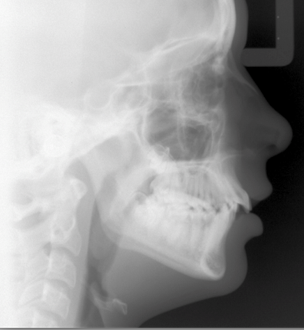 Class II Correction: 3 Evaluations for Optimal Referral Timing Donna Stenberg Class II Correction Figure 1