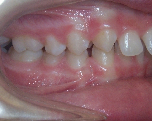 Class II Correction: 3 Evaluations for Optimal Referral Timing Donna Stenberg Class II Correction Figure 2