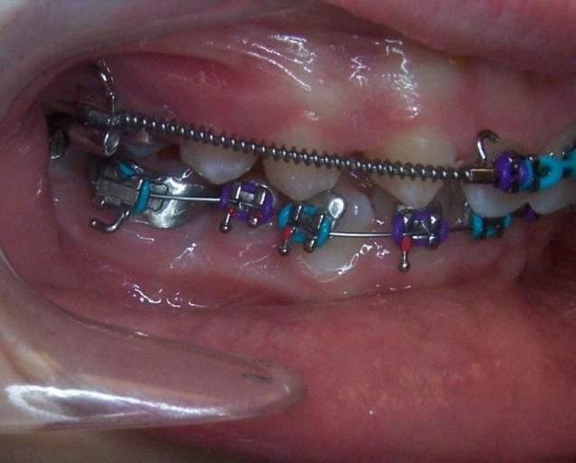 Class II Correction: 3 Evaluations for Optimal Referral Timing Donna Stenberg Class II Correction Figure 3