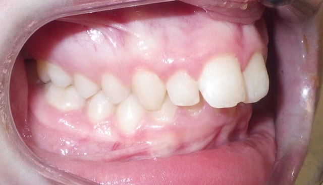 Class II Correction: 3 Evaluations for Optimal Referral Timing Donna Stenberg Class II Correction Figure 6
