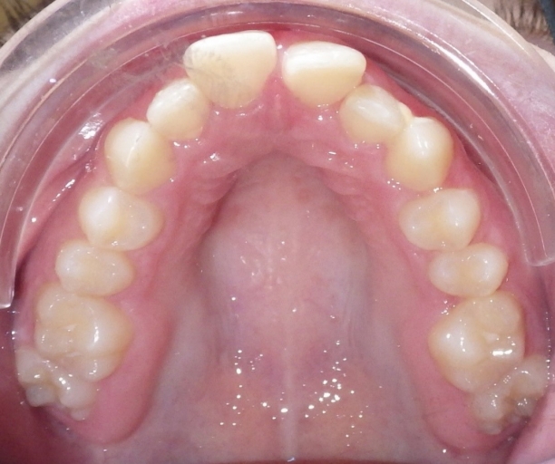 Class II Correction: 3 Evaluations for Optimal Referral Timing Donna Stenberg Class II Correction Figure 7