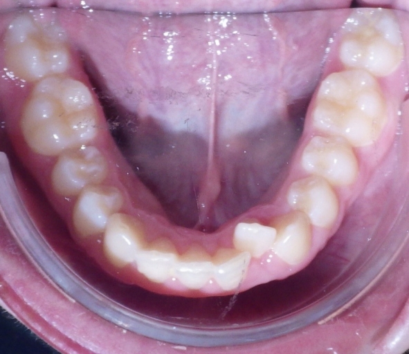 Class II Correction: 3 Evaluations for Optimal Referral Timing Donna Stenberg Class II Correction Figure 8