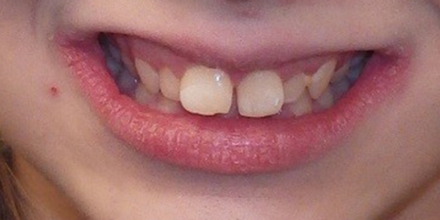 Class II Correction: 3 Evaluations for Optimal Referral Timing Donna Stenberg Class II Correction Figure 9